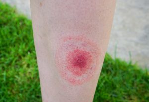 Lyme Disease Long Island