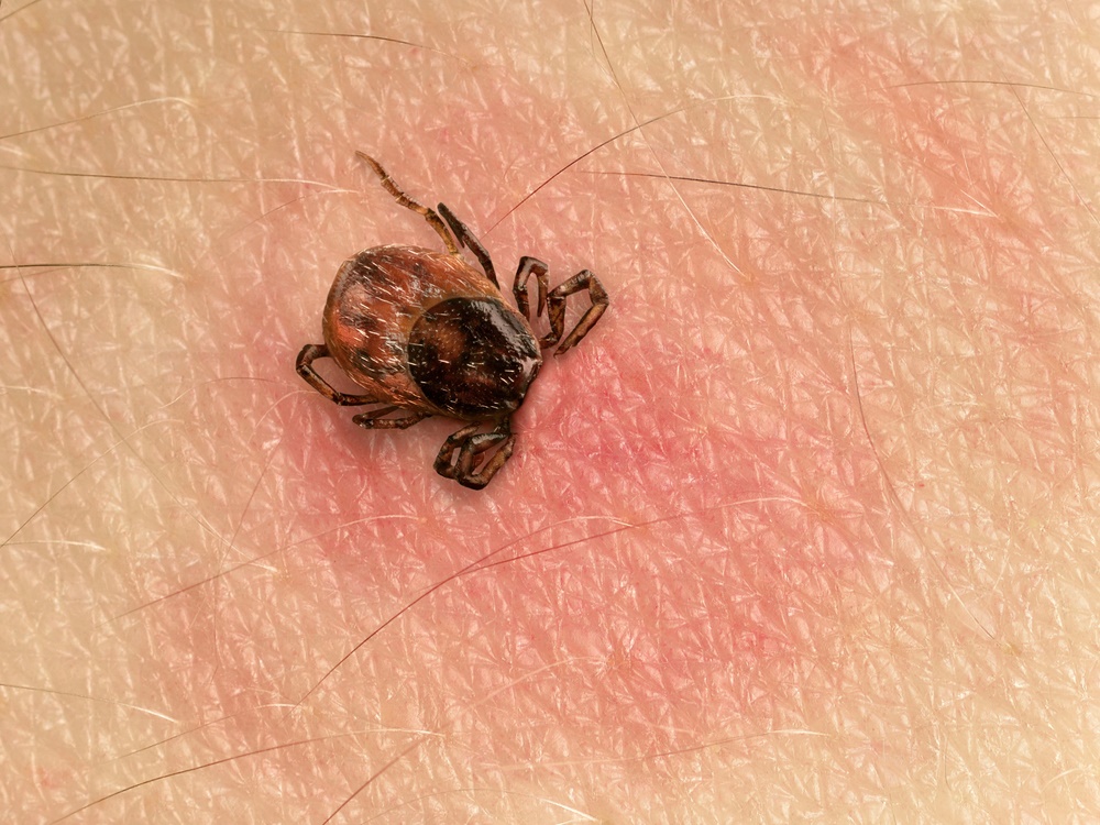 Lyme Disease FAQ