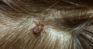 Tick in hair