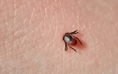 blacklegged tick embedded in skin, raising risk for lyme disease