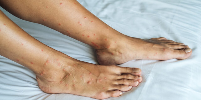 Legs and feet covered in bug bites