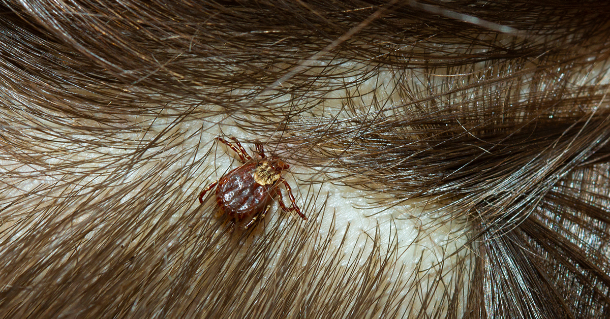 What Is Rocky Mountain Spotted Fever?
