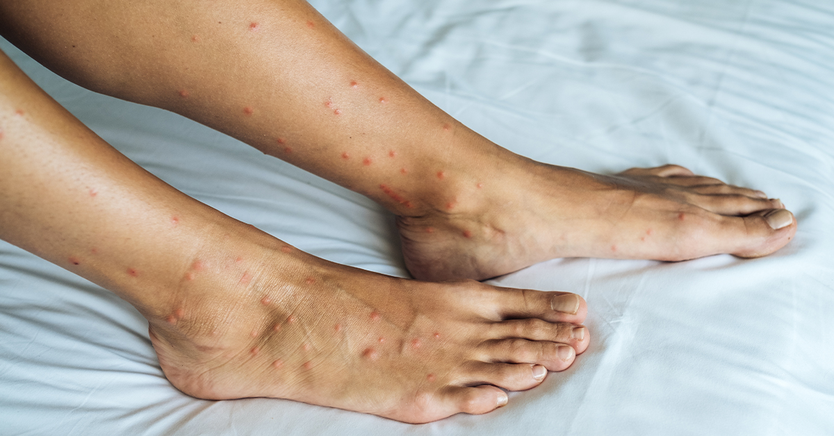 Bed Bug Bites vs Mosquito Bite