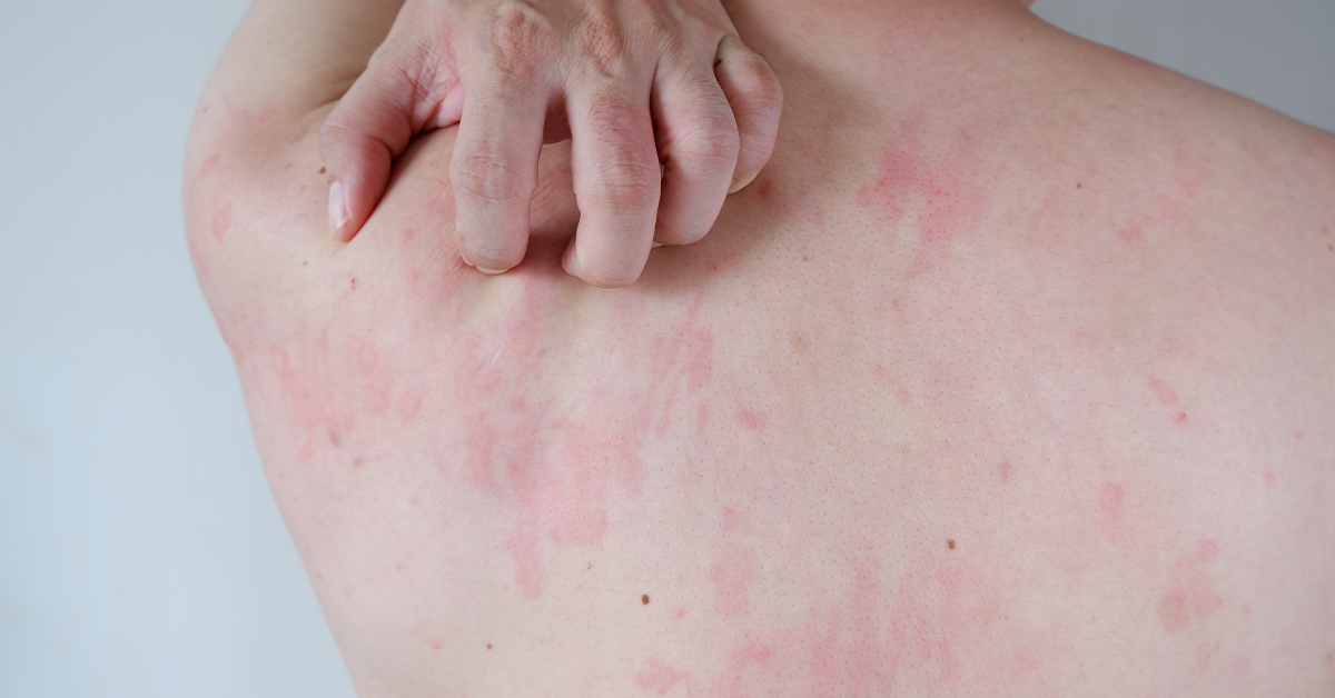 Tick-Borne Disease: Alpha-gal syndrome (AGS)