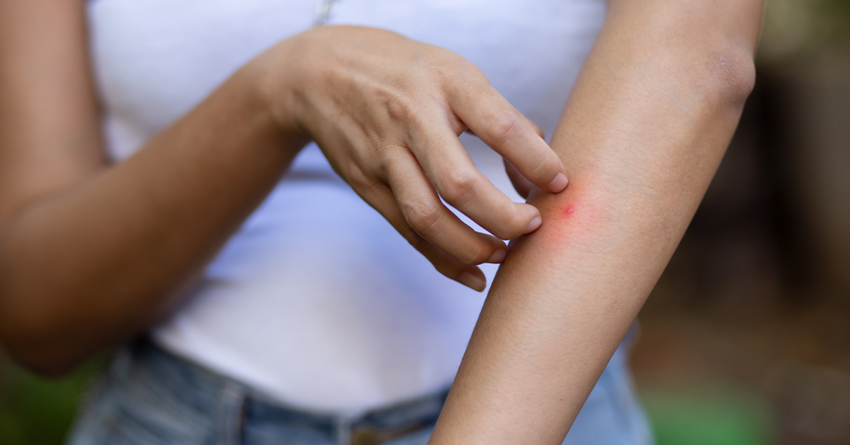 Why Do Mosquito Bites Itch?
