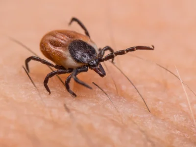 Close-up view of a black-legged tick with a brown and black abdomen crawling near fine hairs on a person's skin.